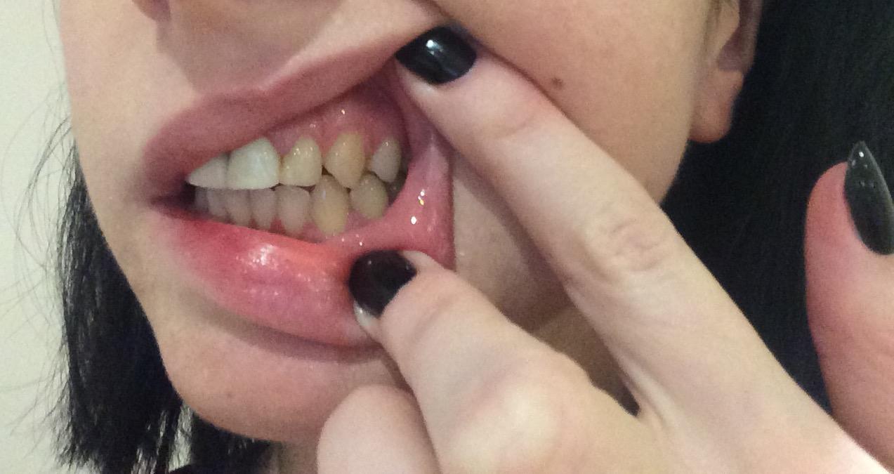 THIS IS WHAT BULIMIA DOES TO YOUR TEETH